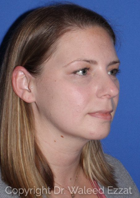 Rhinoplasty Patient Photo - Case 7763 - before view-1