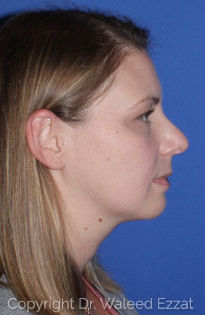 Rhinoplasty Patient Photo - Case 7763 - before view-