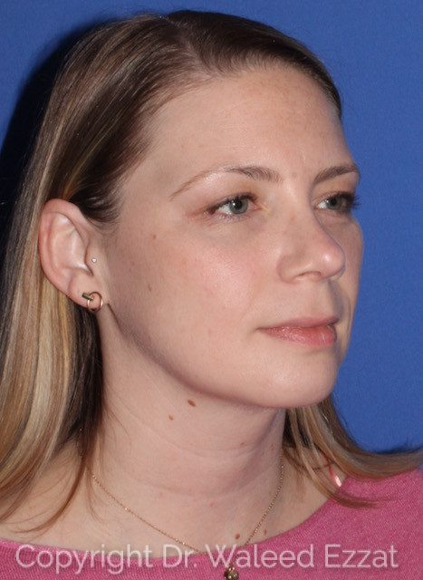 Rhinoplasty Patient Photo - Case 7763 - after view-1