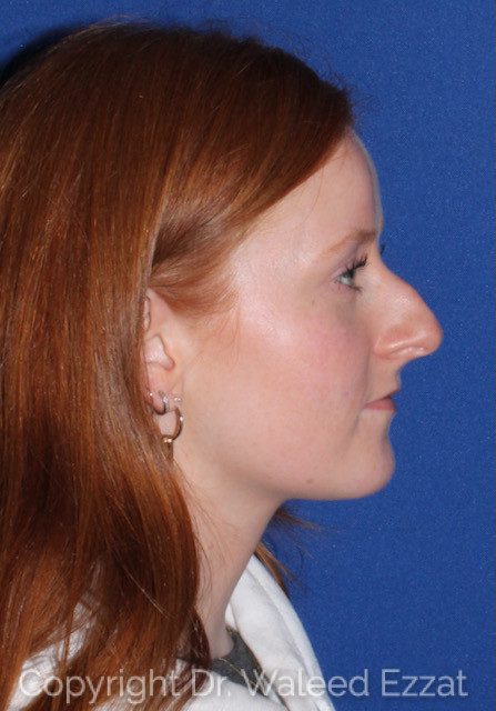 Rhinoplasty Patient Photo - Case 7769 - before view-1