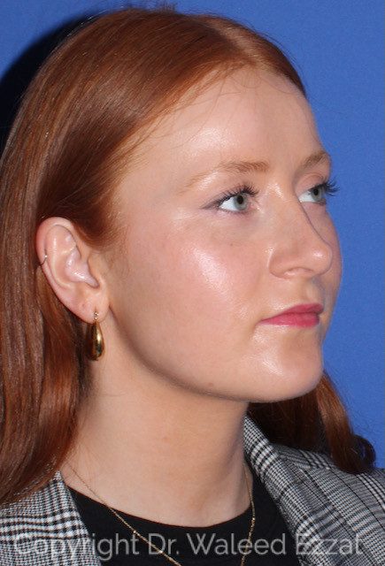 Rhinoplasty Patient Photo - Case 7769 - after view