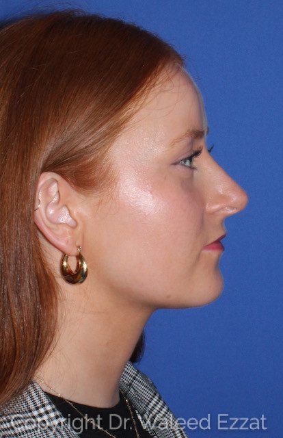 Rhinoplasty Patient Photo - Case 7769 - after view-1