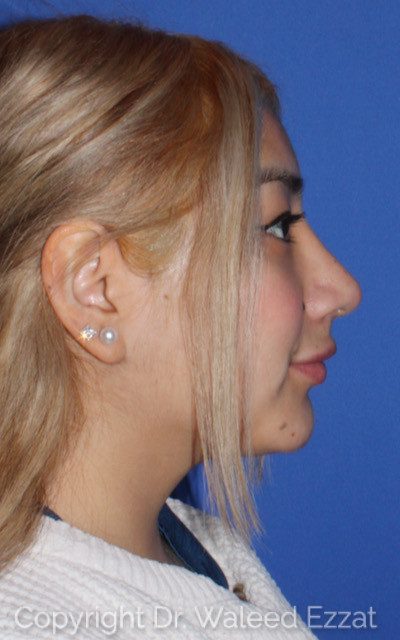Hispanic/South American Rhinoplasty Patient Photo - Case 7775 - after view