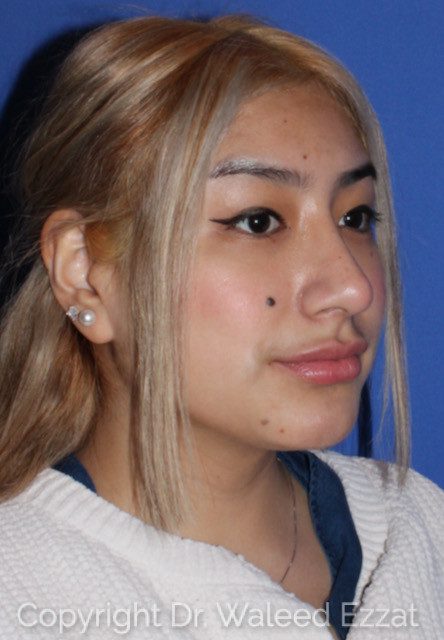 Rhinoplasty Patient Photo - Case 7775 - after view-1