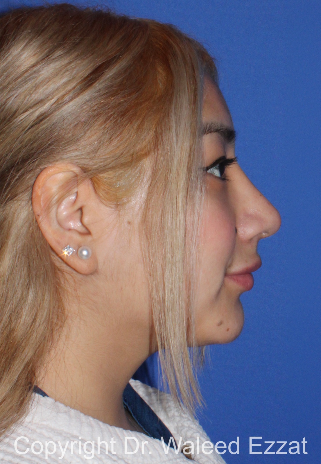 Hispanic/South American Rhinoplasty Patient Photo - Case 291 - after view