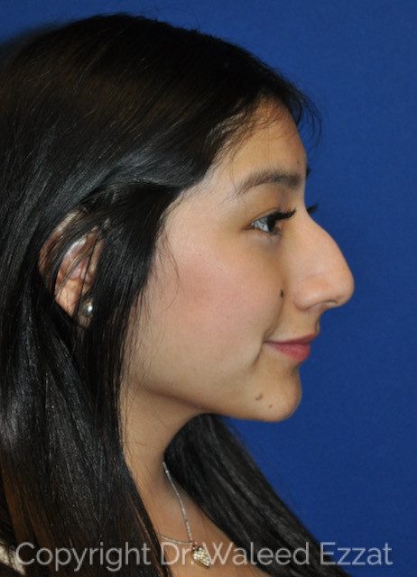 Hispanic/South American Rhinoplasty Patient Photo - Case 7775 - before view-