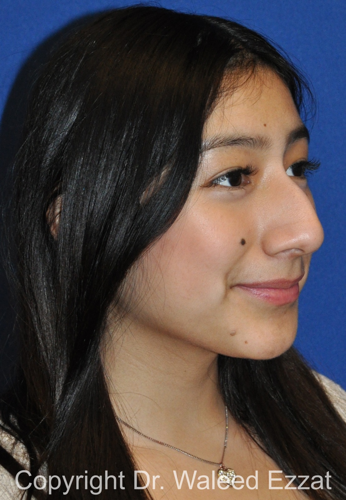 Hispanic/South American Rhinoplasty Patient Photo - Case 291 - before view-1
