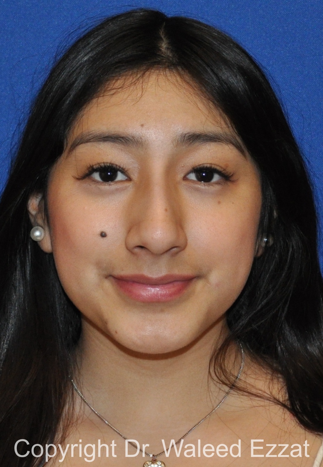 Hispanic/South American Rhinoplasty Patient Photo - Case 291 - before view-2