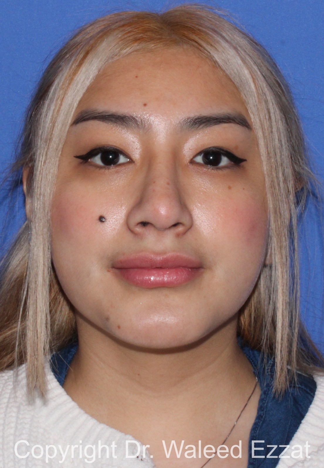 Hispanic/South American Rhinoplasty Patient Photo - Case 291 - after view-2