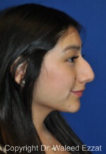 Hispanic/South American Rhinoplasty - Case 291 - Before