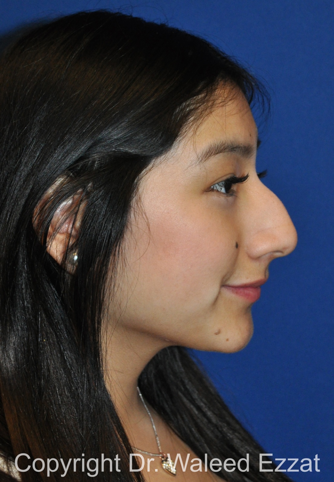 Hispanic/South American Rhinoplasty Patient Photo - Case 291 - before view-