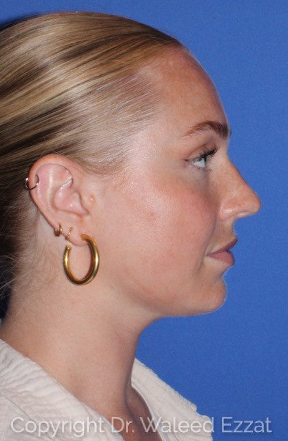 Rhinoplasty Patient Photo - Case 7783 - before view-2