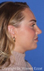 Caucasian/European Rhinoplasty - Case 82 - After