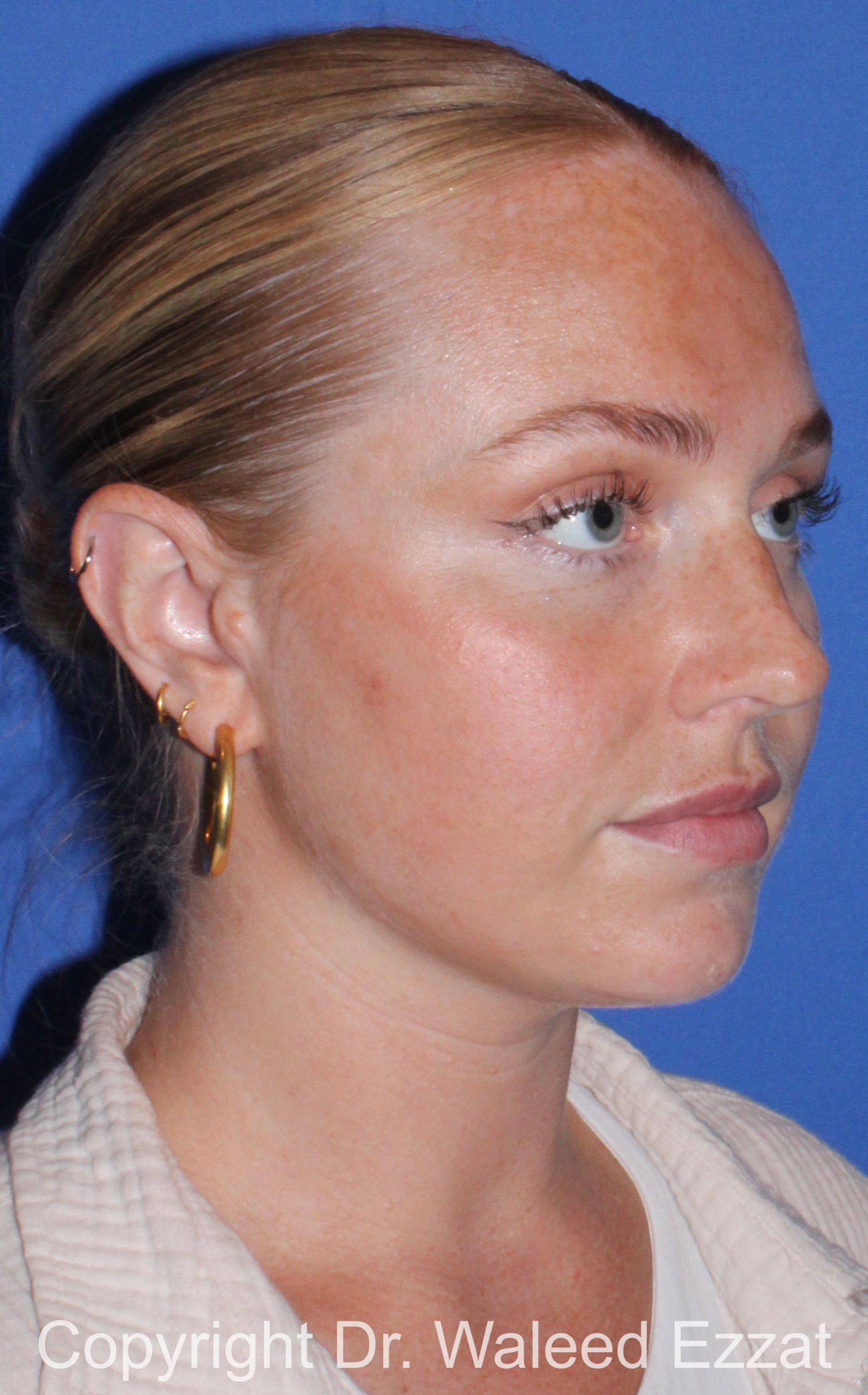 Caucasian/European Rhinoplasty Patient Photo - Case 82 - before view-1