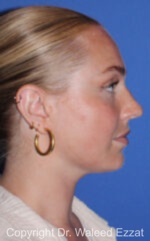Caucasian/European Rhinoplasty - Case 82 - Before