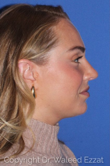 Rhinoplasty Patient Photo - Case 7783 - after view-2