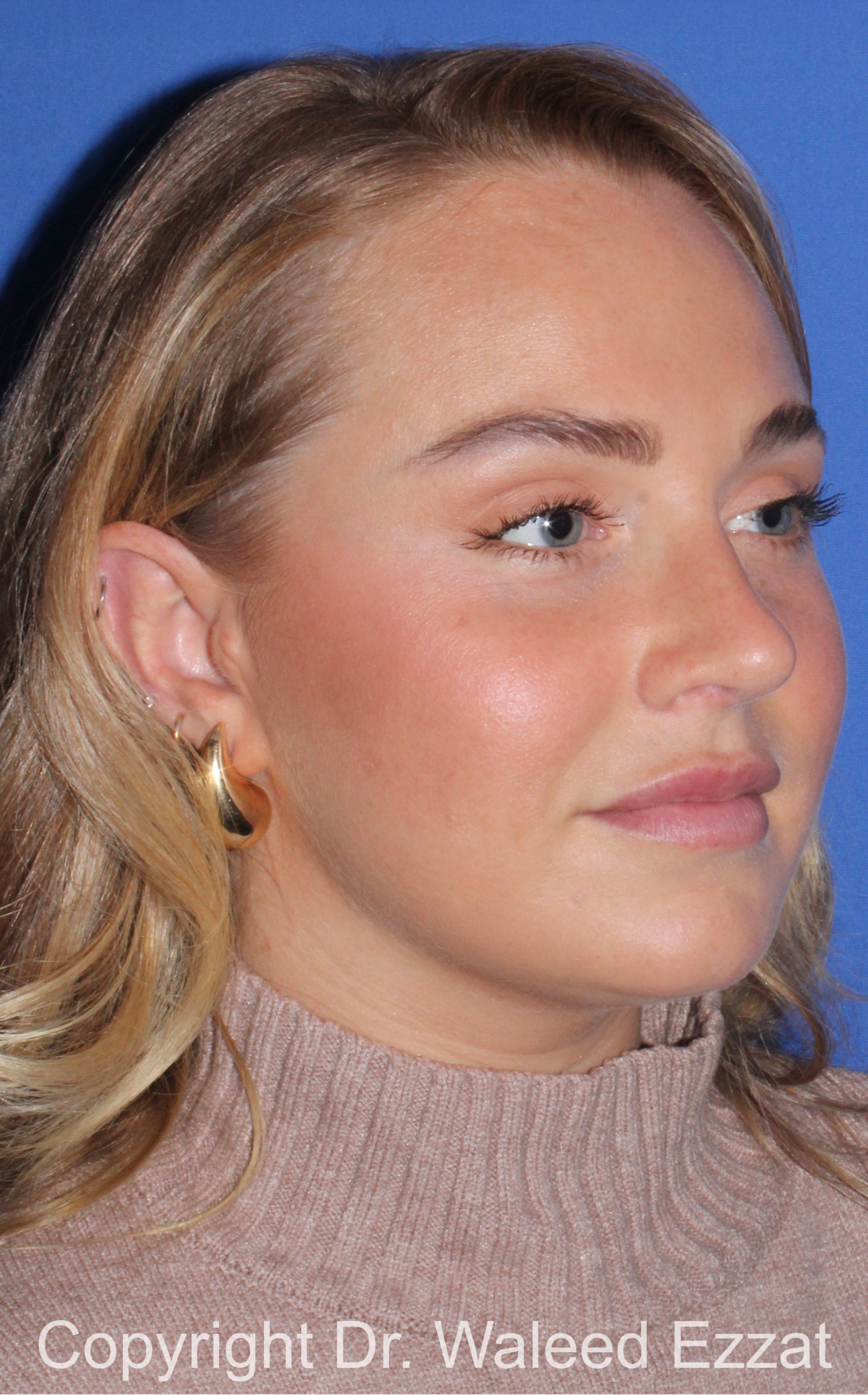 Caucasian/European Rhinoplasty Patient Photo - Case 82 - after view-1