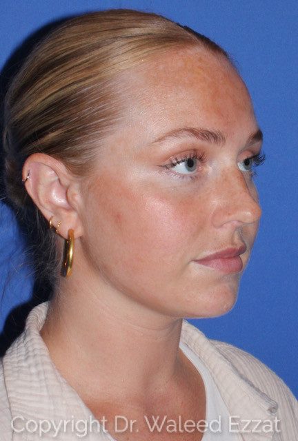 Rhinoplasty Patient Photo - Case 7783 - before view-