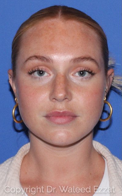 Rhinoplasty Patient Photo - Case 7783 - before view-1