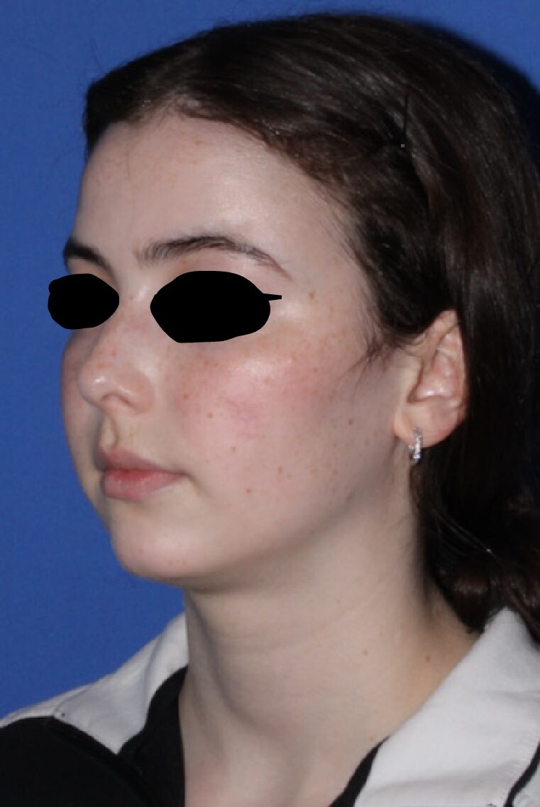 Mole Removal Patient Photo - Case 7810 - before view-