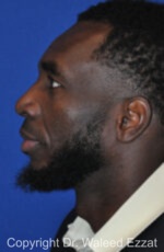 African/Caribbean Rhinoplasty - Case 201 - After