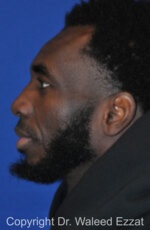 African/Caribbean Rhinoplasty - Case 201 - Before