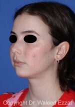 Mole Removal - Case 123 - Before