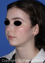 Mole Removal - Case 123 - After