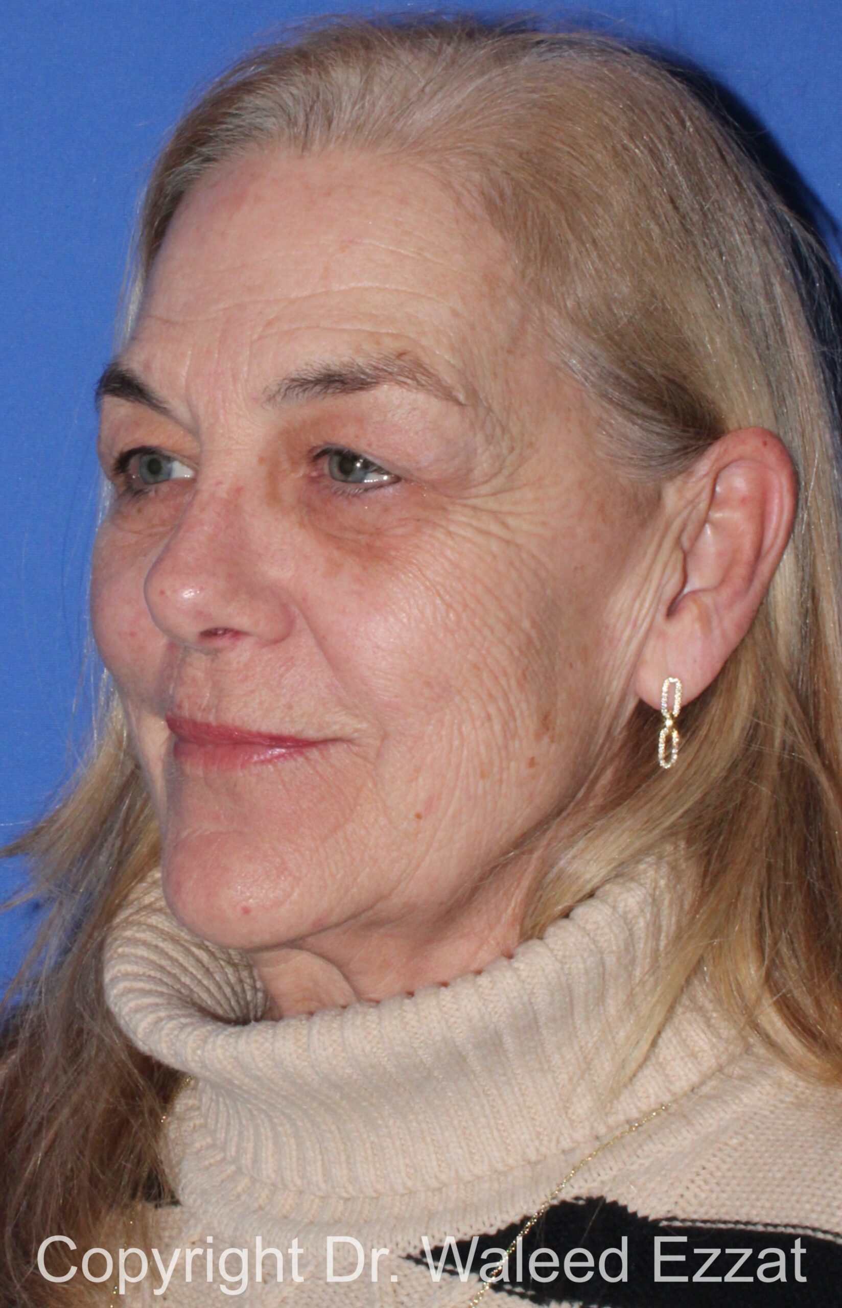 Blepharoplasty Patient Photo - Case 14 - before view-1