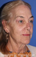 Blepharoplasty - Case 14 - After