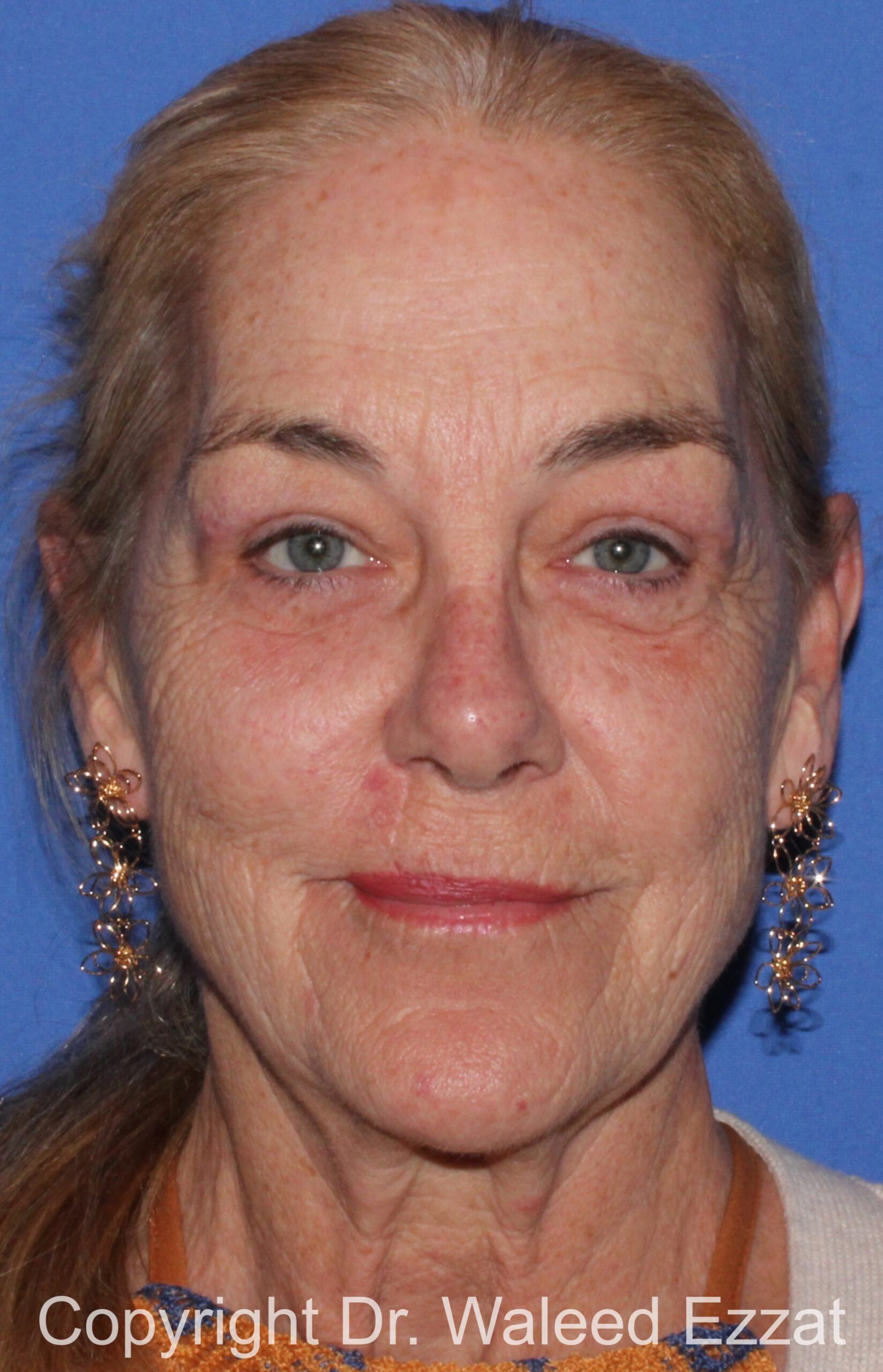 Blepharoplasty Patient Photo - Case 14 - after view-2