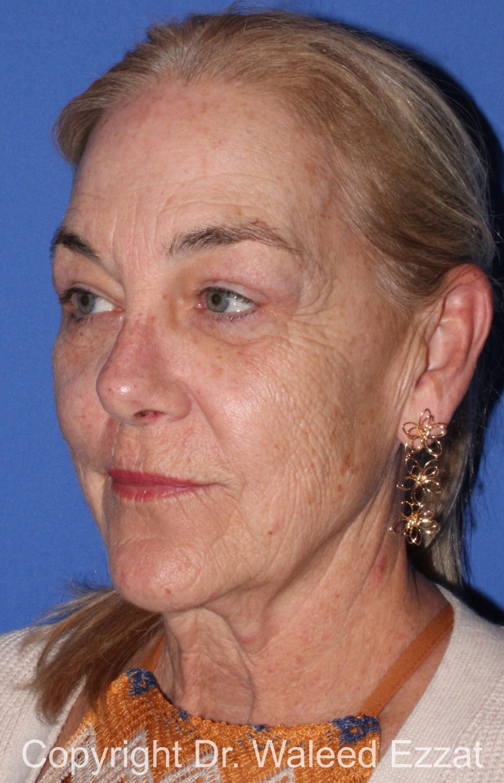 Blepharoplasty Patient Photo - Case 14 - after view-1