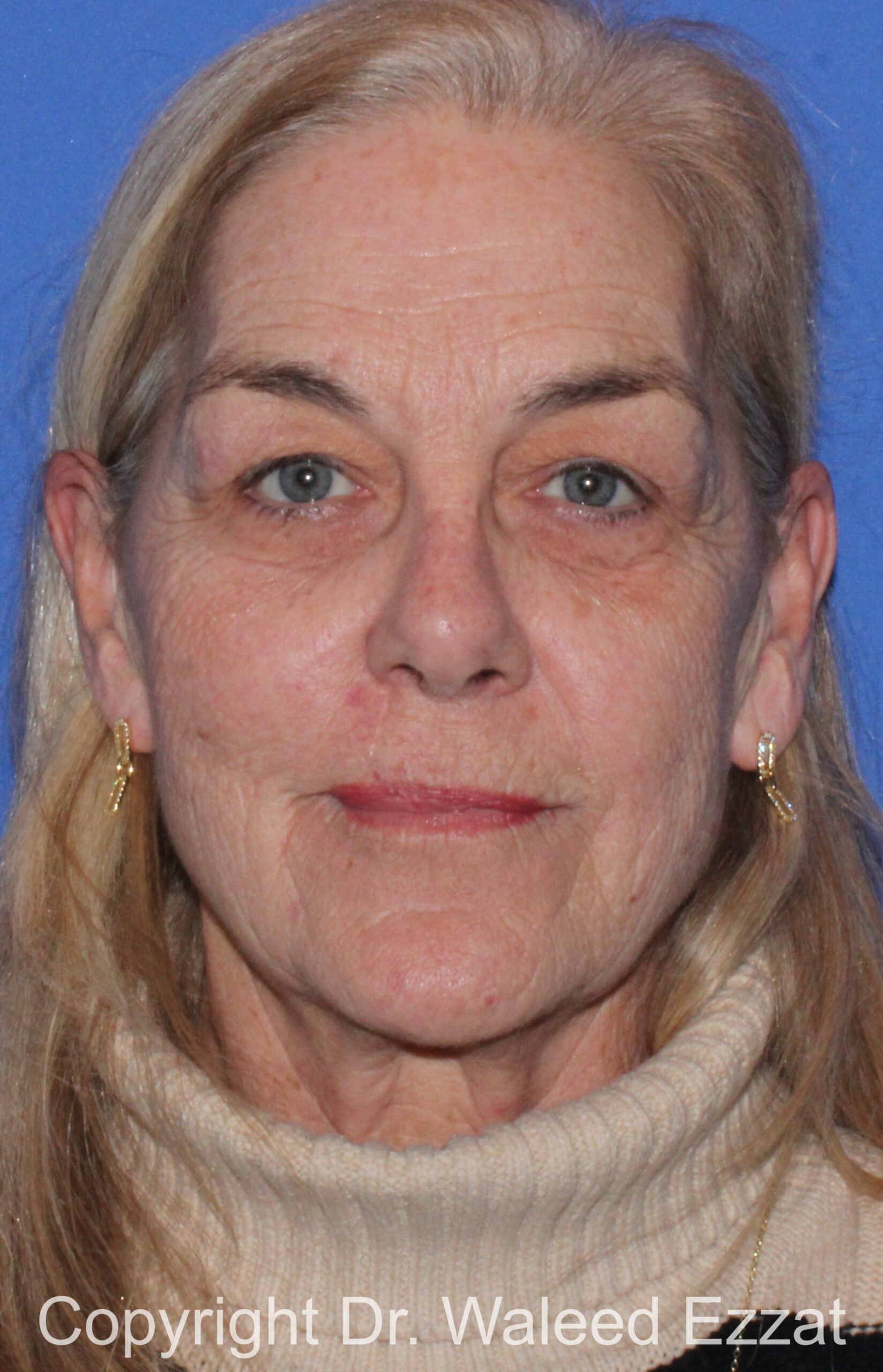 Blepharoplasty Patient Photo - Case 14 - before view-2