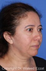 Blepharoplasty - Case 16 - Before