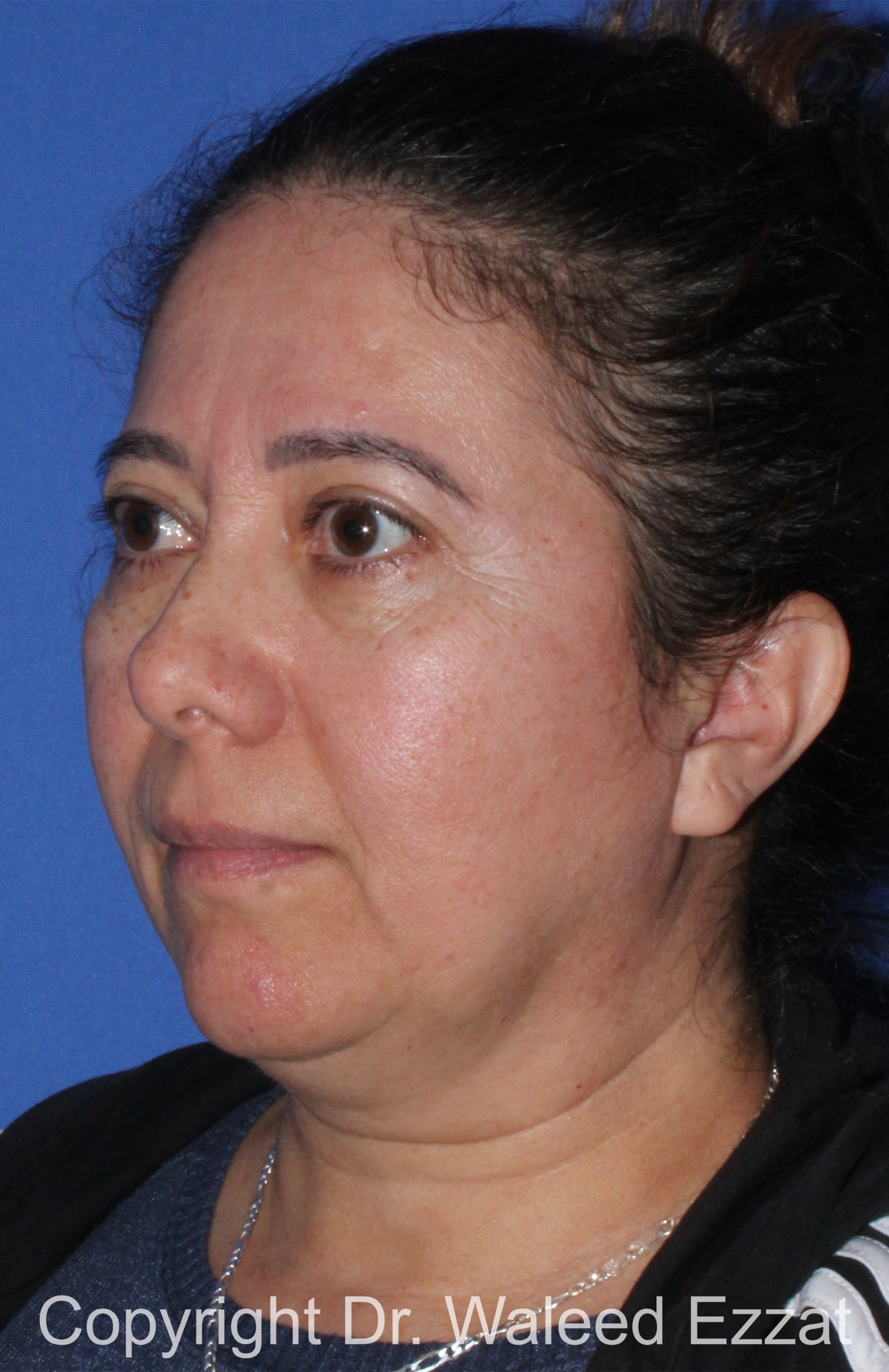 Blepharoplasty Patient Photo - Case 16 - after view-1