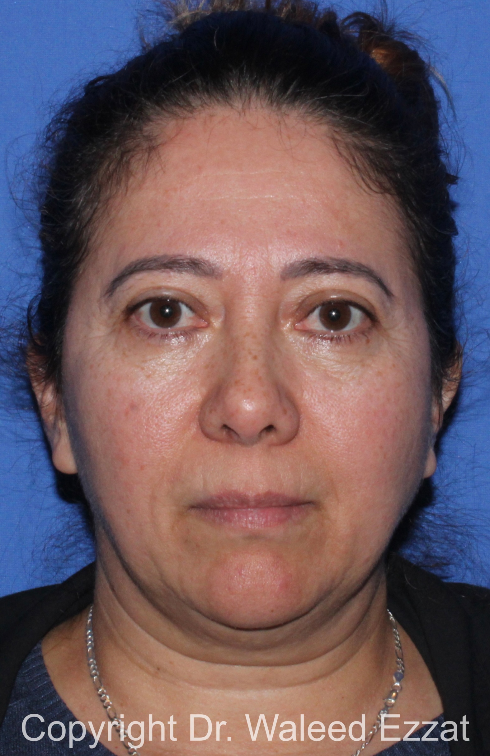 Blepharoplasty Patient Photo - Case 16 - after view-2