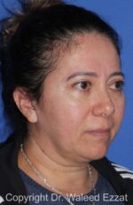 Blepharoplasty - Case 16 - After