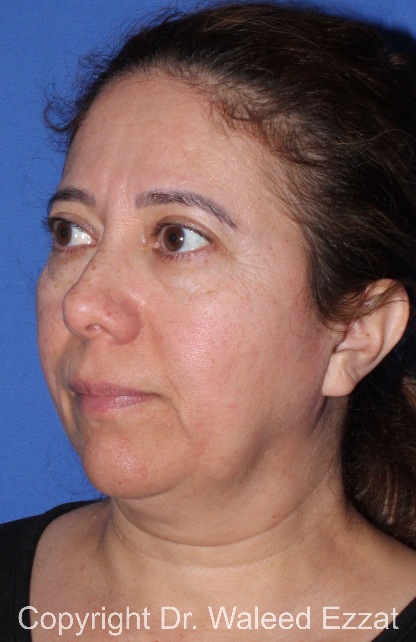 Blepharoplasty Patient Photo - Case 16 - before view-1