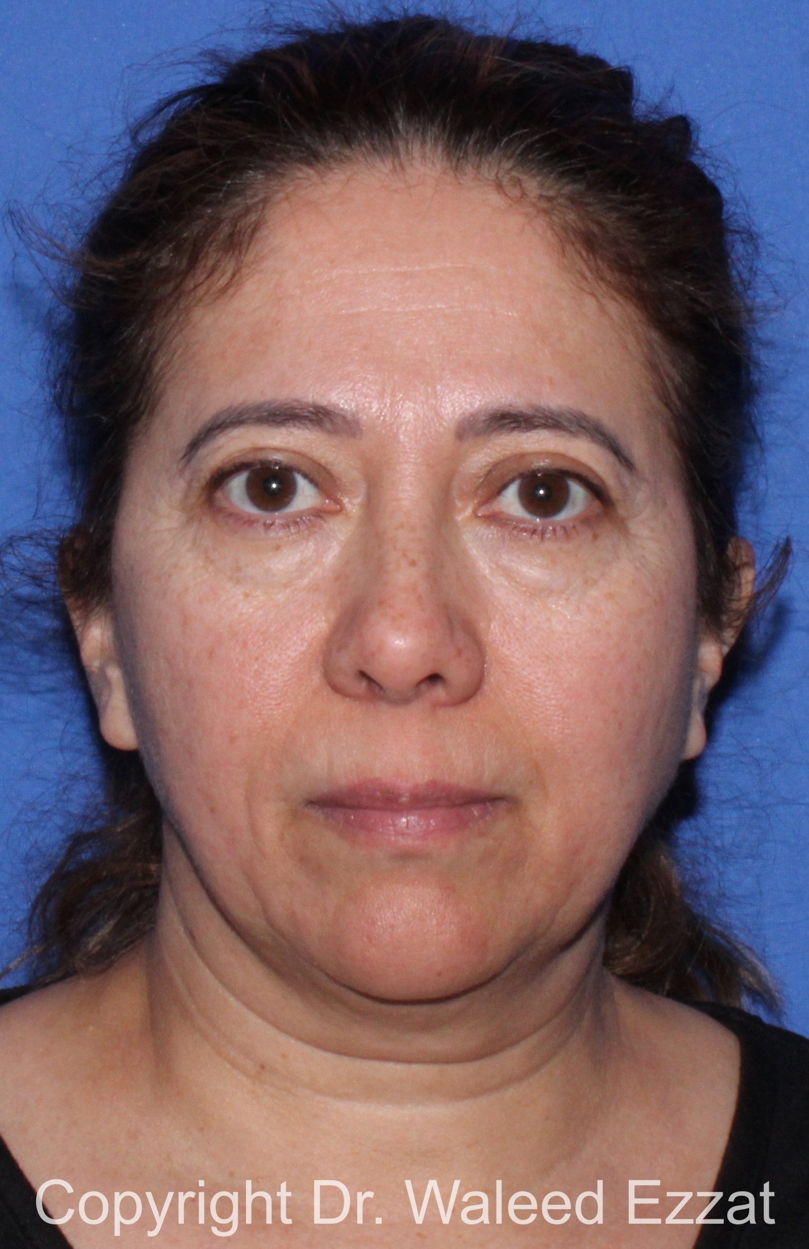 Blepharoplasty Patient Photo - Case 16 - before view-2