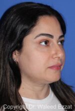 Blepharoplasty - Case 19 - After