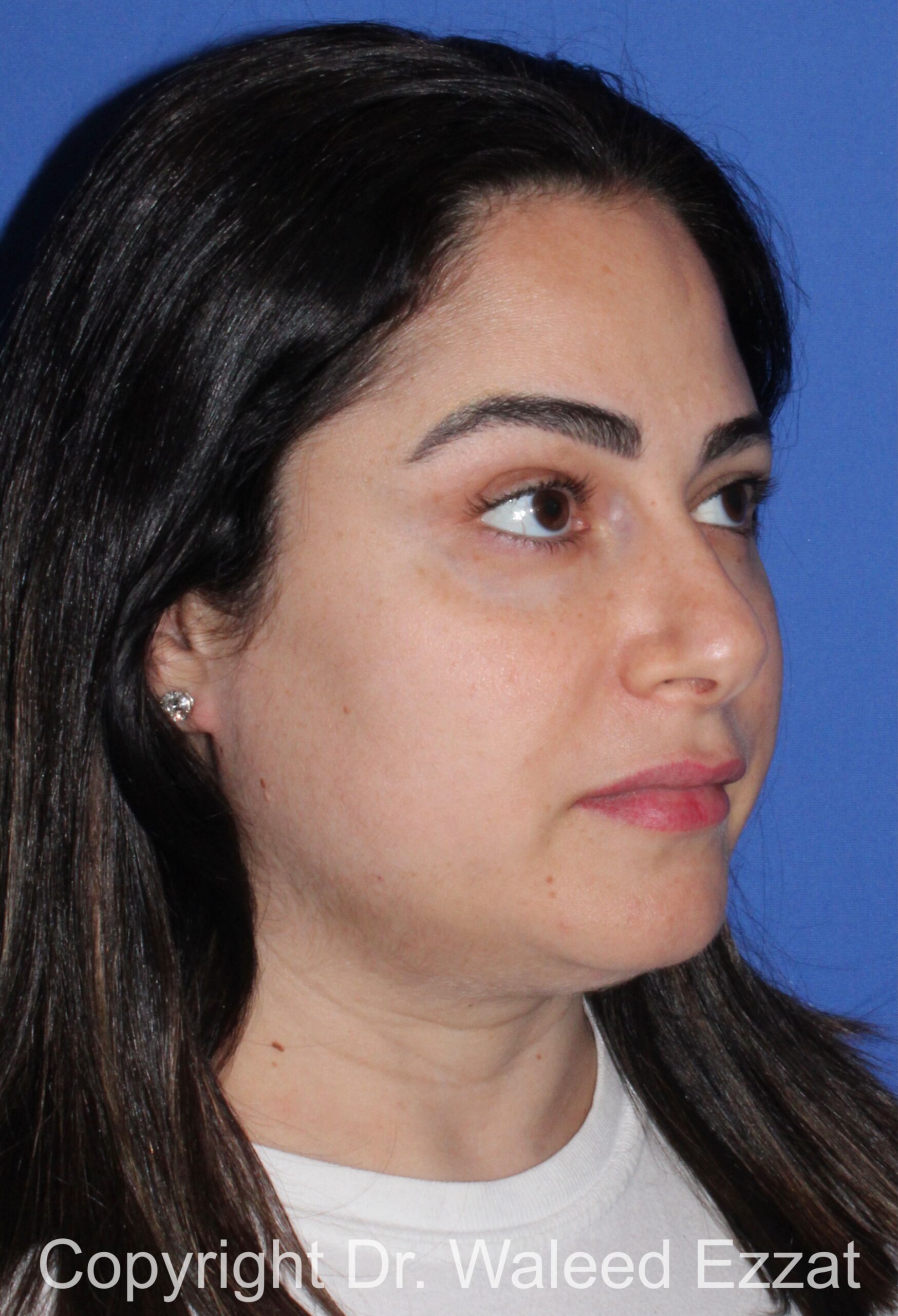 Blepharoplasty Patient Photo - Case 19 - after view