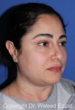 Blepharoplasty - Case 19 - Before