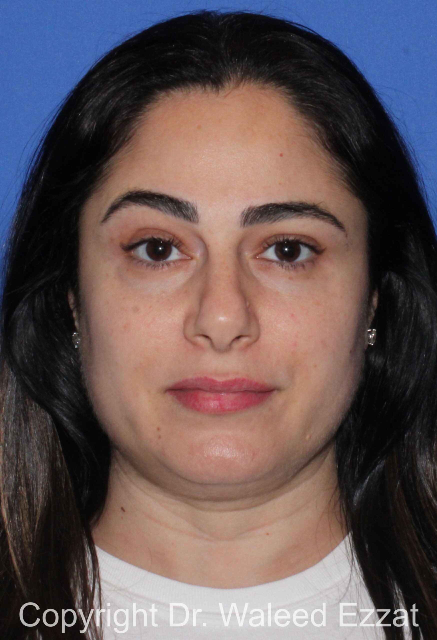 Blepharoplasty Patient Photo - Case 19 - after view-2