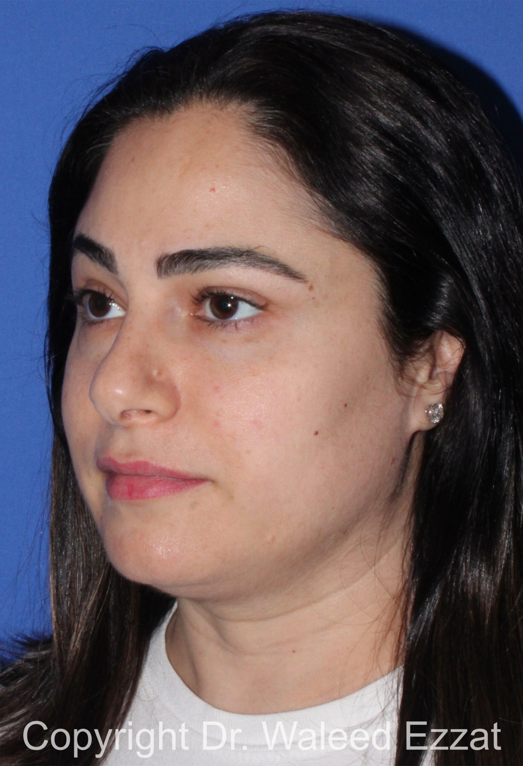 Blepharoplasty Patient Photo - Case 19 - after view-1