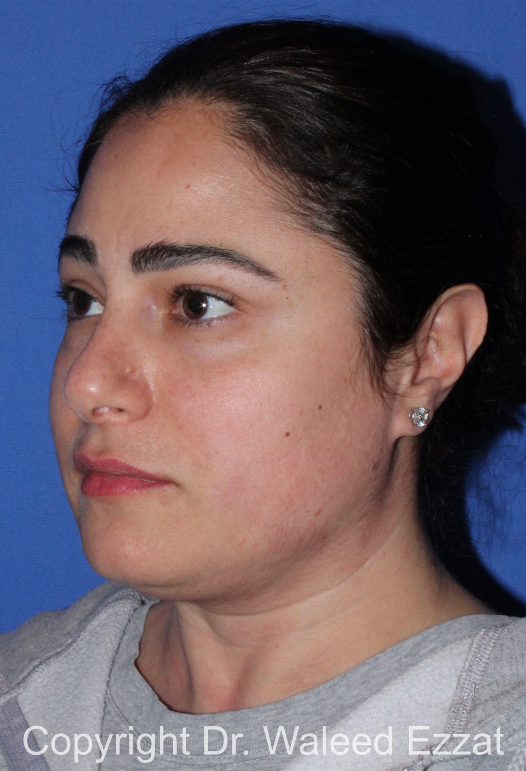 Blepharoplasty Patient Photo - Case 19 - before view-1