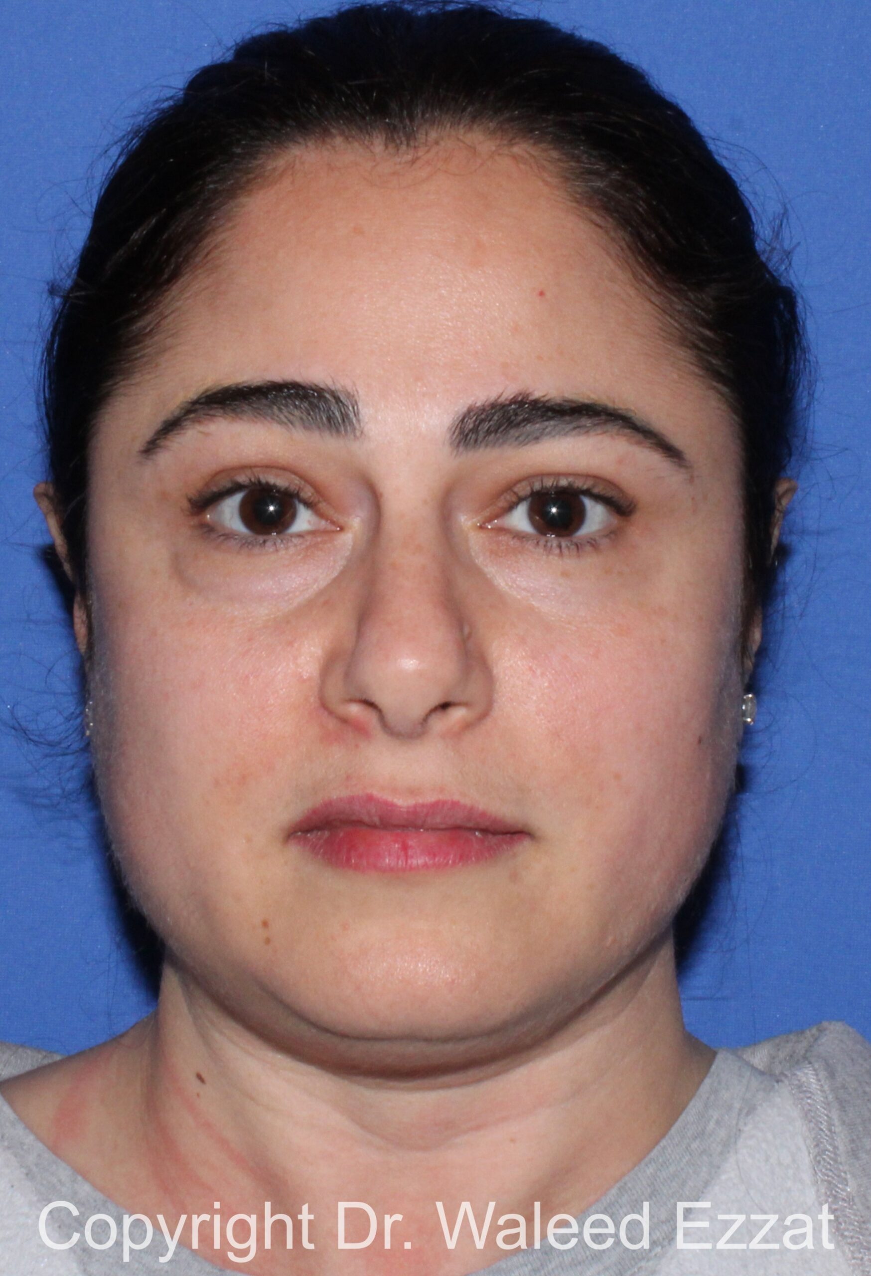 Blepharoplasty Patient Photo - Case 19 - before view-2