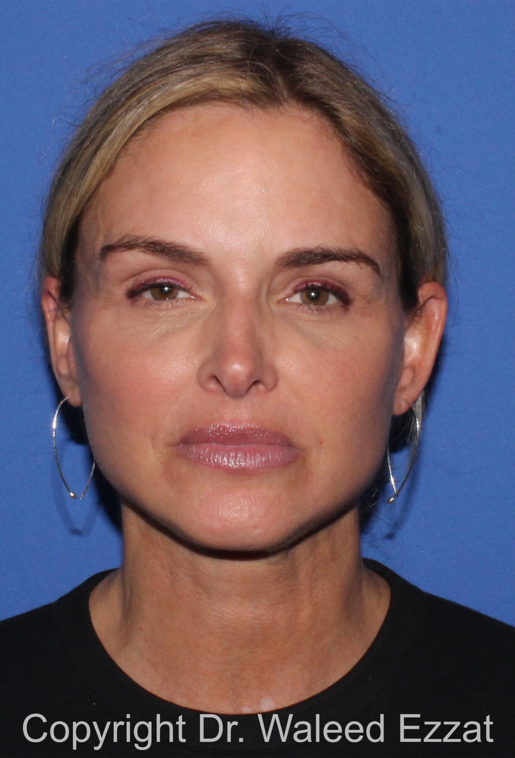 Brow Lift Patient Photo - Case 20 - before view-2