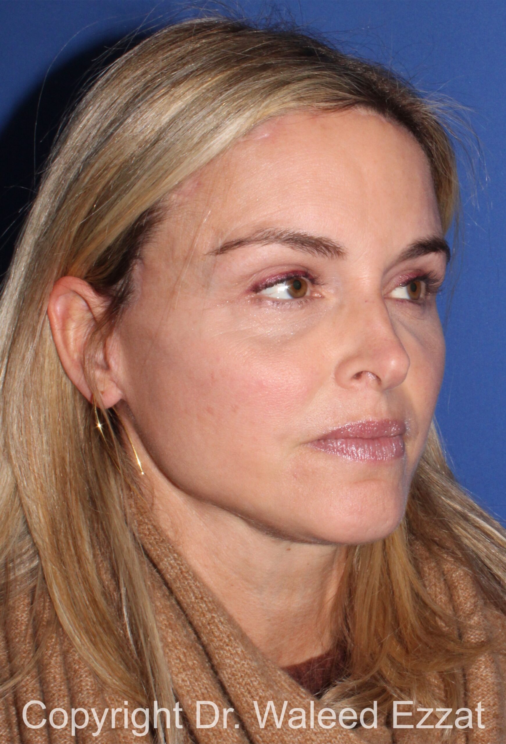 Brow Lift Patient Photo - Case 20 - after view