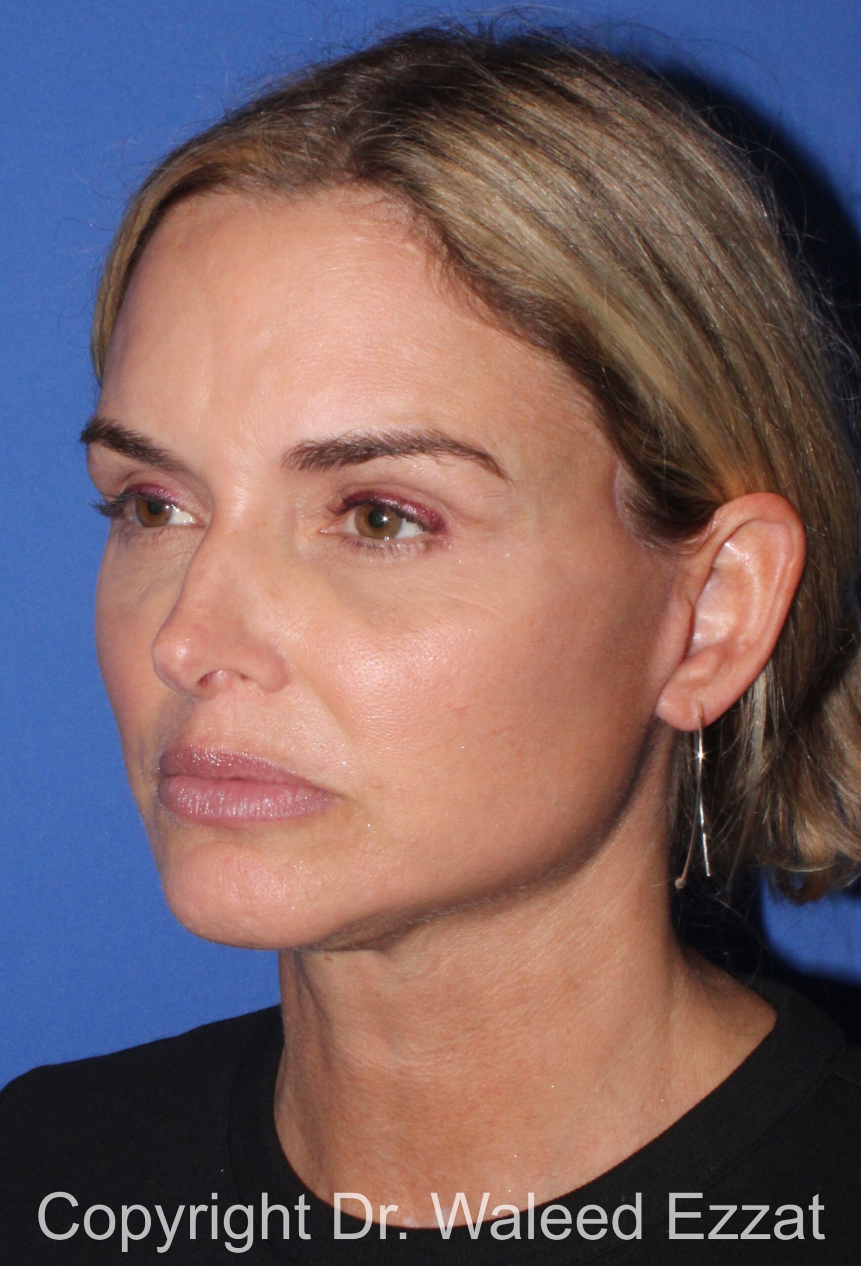 Brow Lift Patient Photo - Case 20 - before view-1