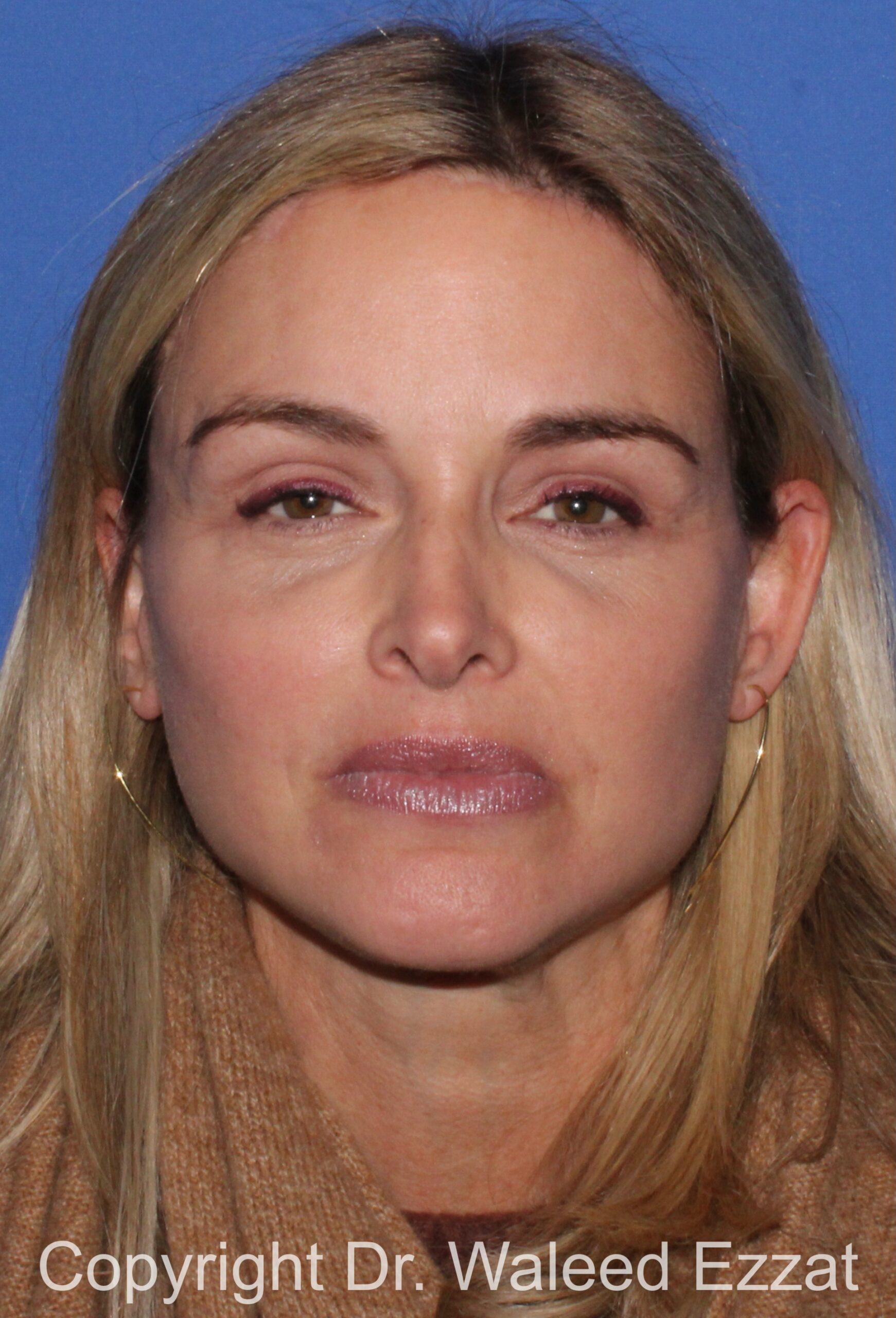 Brow Lift Patient Photo - Case 20 - after view-2